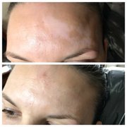Before & Immediately After Vitiligo Camouflage