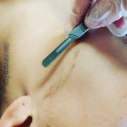 Dermaplaning!