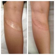 Before & After Burn Scar Camouflage