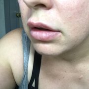 Clusters of blisters