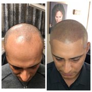 Full Top of Head treated with SMP