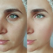 Botox/Filler Before After