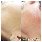 Bye bye peach Fuzz with Dermaplaning!
