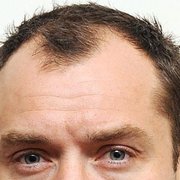 Transplants can be costly and provide a temporary solution to a receding hairline.  But, SMP can give you back an age appropriate look!