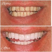 Before and After smile transformation