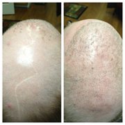 Before & After Scar Camouflage and Initial Session of SMP