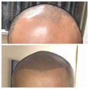 Hairline & Full Top of Head SMP completed at North State Scalp Center.