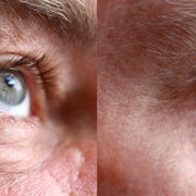Eye Before After