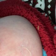 burned peeling after 2 weeks! scar
