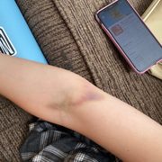 The bruise from the IV 1 week after.