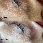 extractions