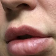 Cluster of blisters
