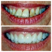 Actual Patient: Before and After- Smile Makeover Forest Avenue Dental
