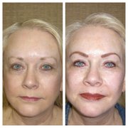 Full Face Immediately After