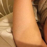 This is the back side of my arm. Both arms and both of my sisters arms have multiple areas like this.