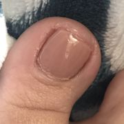 Jagged toenail cut too short. Terrible gel job too.