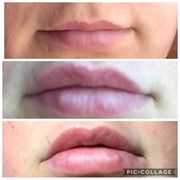 Top-right before first appointment. Middle-2 weeks after 1st appointment. Bottom- a few days after 2nd appointment.