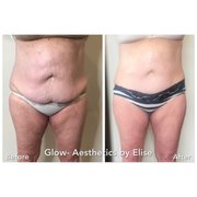 After 10 sessions this beauty is feeling incredible!