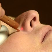 Gemini Laser to treat vessels on face and chest