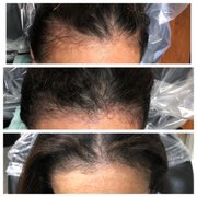 Before, Immediately After and Healing Hairline Definition SMP