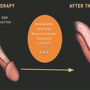 PRP P Shot