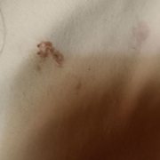 Blood left from bedbug on sheets
