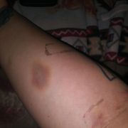 The bruise from the nurse who wiggled the needle around inside me hard. The IV bruises don't even compare. Please excuse tape marks