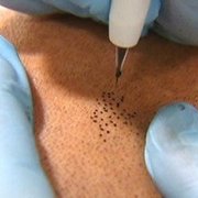 A small scar or an entire bald head, SMP will transform the way you look at hair loss!