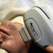 Intense Pulsed light for removal of sun damage.
