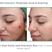 vipeel acne peel results