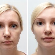 Dermal Filller/ Before After