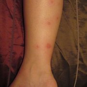 Bed bug bites from my stay at Holiday Inn Chico.