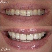 Before and After
Smile makeover
