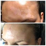 Before & After Vitiligo Tattooing