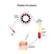 PRP Treatment